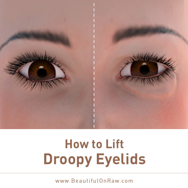 drooping of upper eyelid