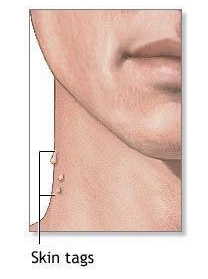 Hpv testing for head and neck cancer Papilloma on the neck